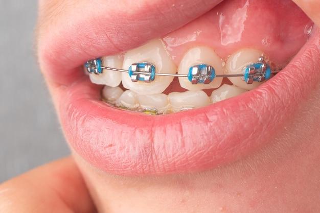 Are you supposed to eat with rubber bands on your braces? 