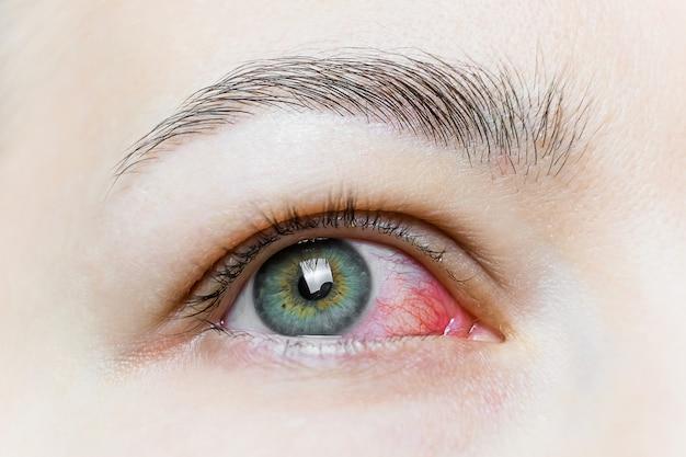 What happens if I get hydraulic fluid in my eye? 