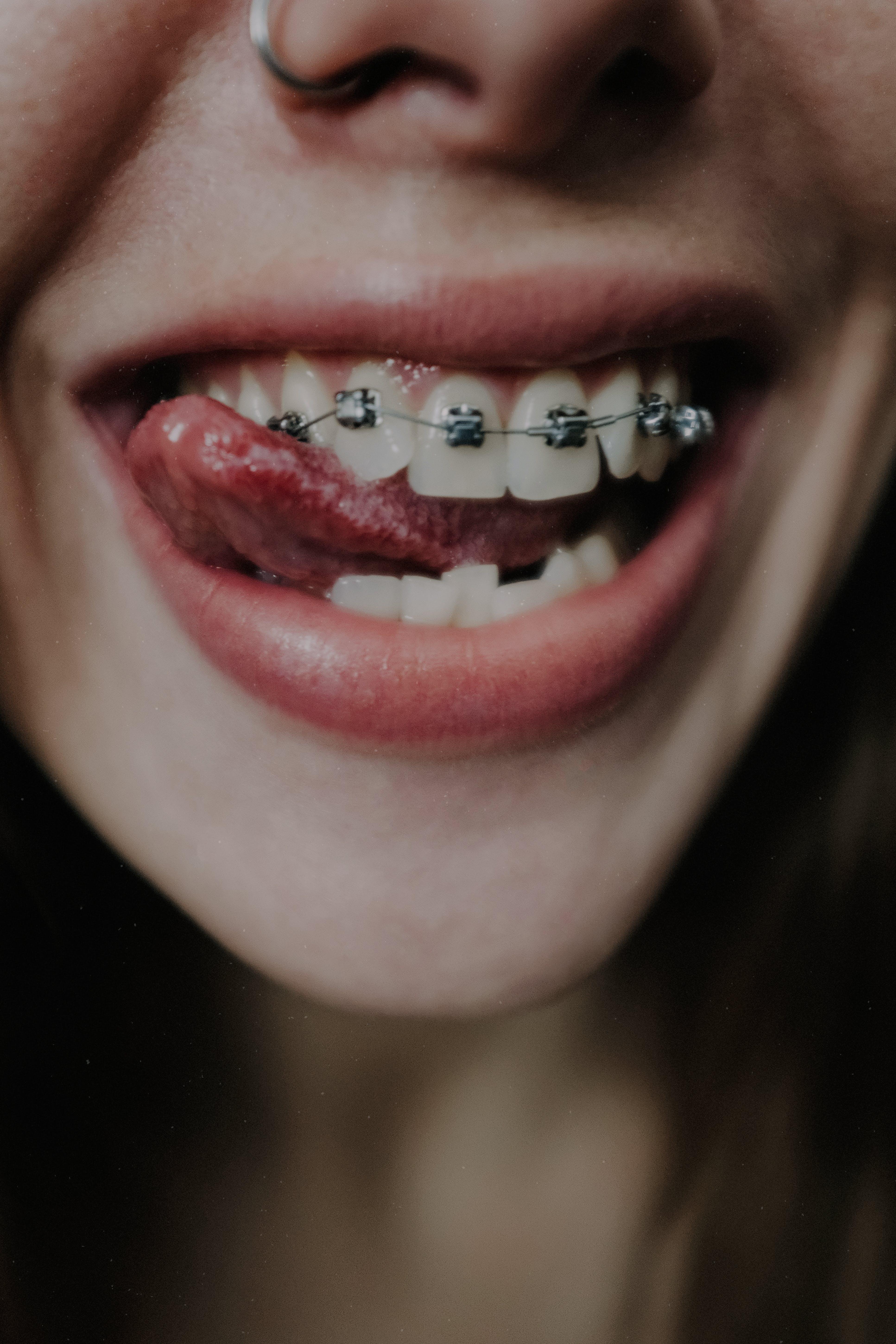 Do braces make you look more attractive? 