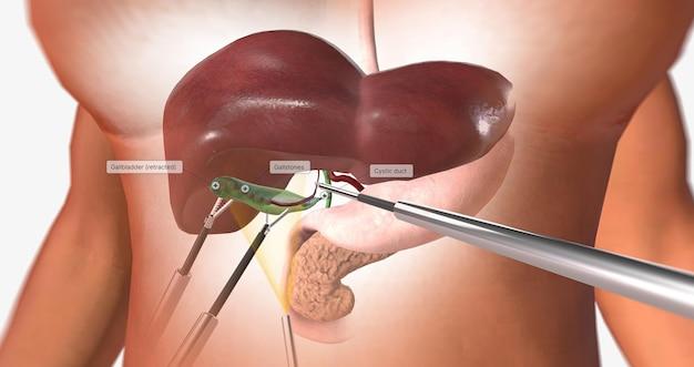 What causes high bilirubin after gallbladder removal? 