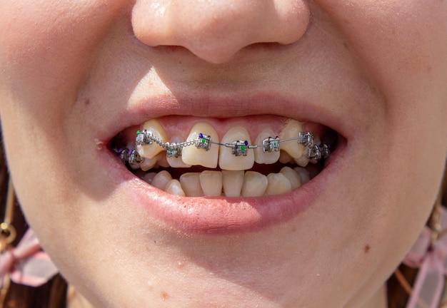 Can you buy fake braces? 