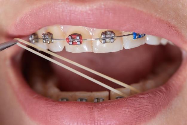 Can you get braces with a flipper tooth? 