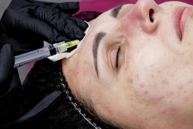 Can you use hyaluronic acid after a chemical peel? 