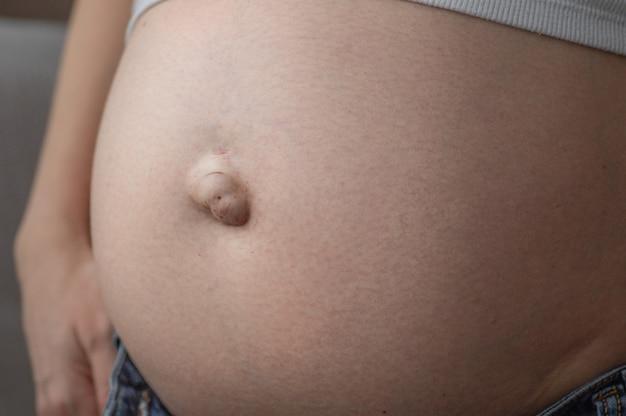How long does it take for swelling to go down after umbilical hernia surgery? 