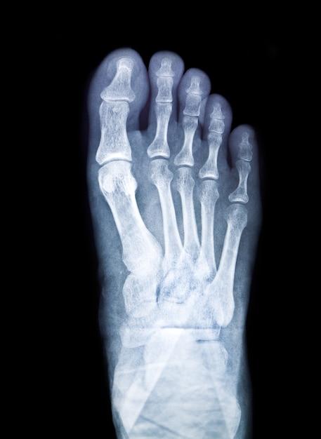 How long does it take to recover from 5th metatarsal surgery? 