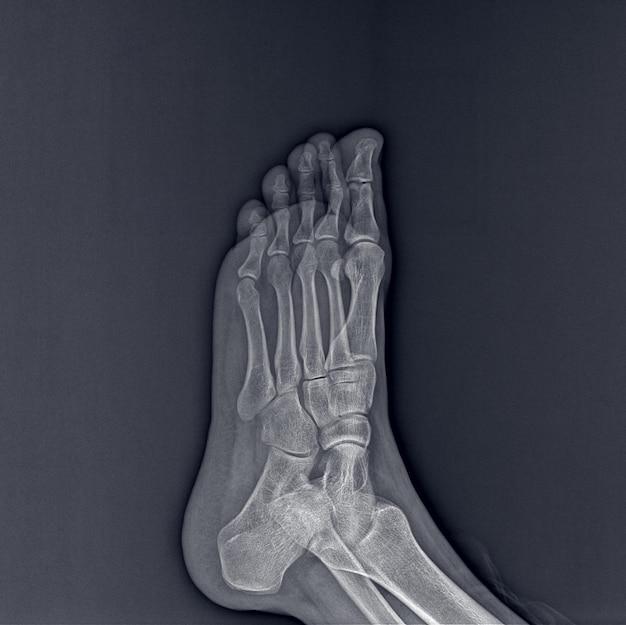How long does it take to recover from 5th metatarsal surgery? 