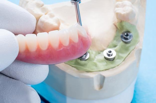 How long does temporary dental cement last? 