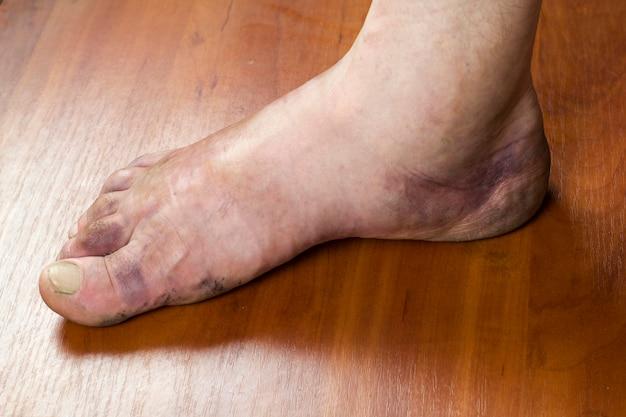 how-long-does-your-ankle-stay-swollen-after-a-fracture-ap-pgecet