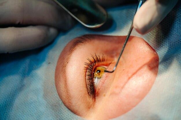 How soon after cataract surgery can I exercise? 