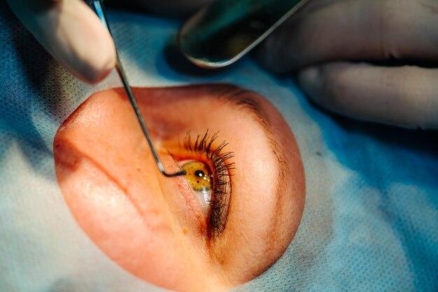 How soon after cataract surgery can I exercise? 