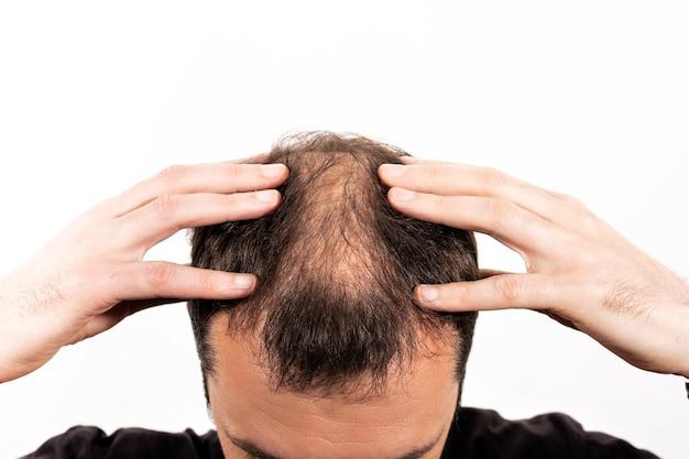 Is losing 200 hairs a day normal? 
