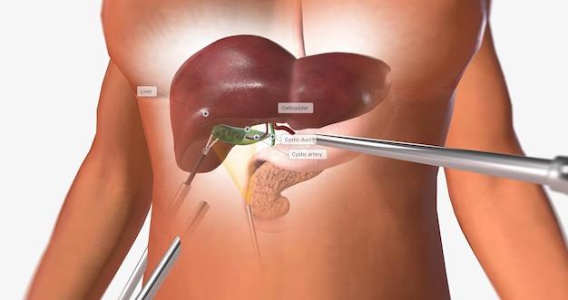 What body cavity would be opened for removal of the gallbladder? 