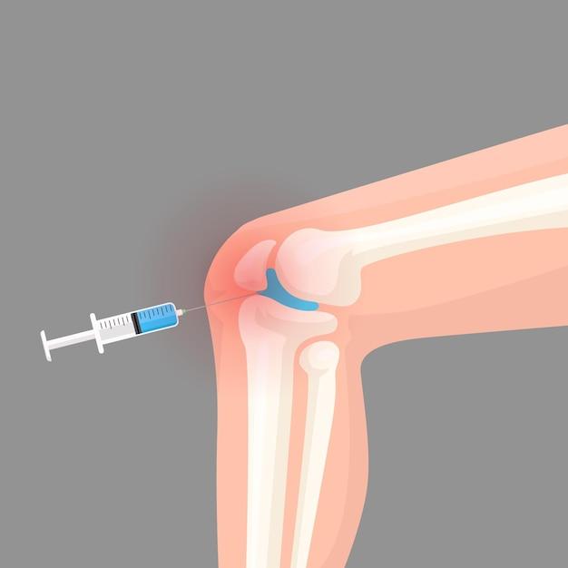 What can go wrong with a cortisone injection? 