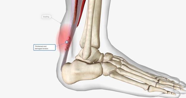 What muscles insert by calcaneal tendon? 