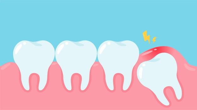 How soon can you lift after wisdom teeth? 