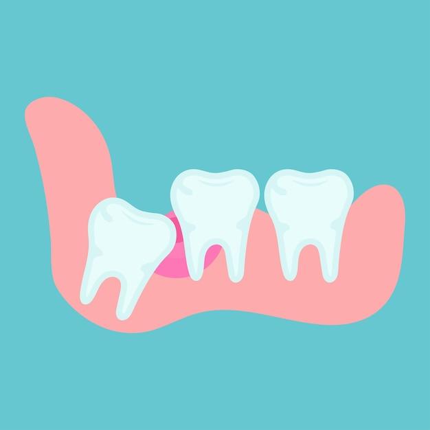 Can you control what you say after wisdom teeth removal? 